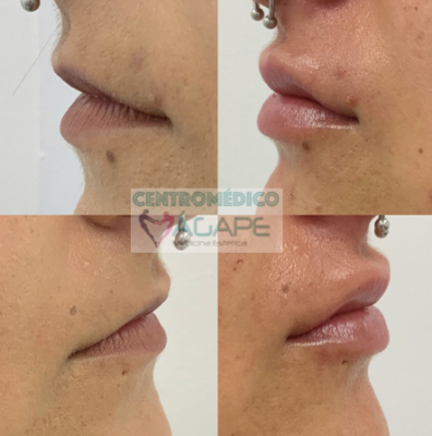 Labios con �cido hialur�nico