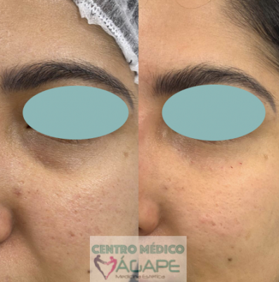 Tratamiento para ojeras