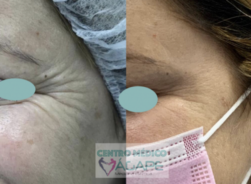 Arrugas patas de gallo