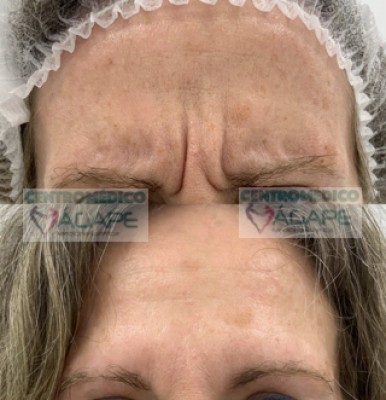 Elimina arruga del entrecejo