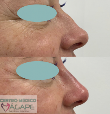 Rinomodelaci�n sin cirug�a