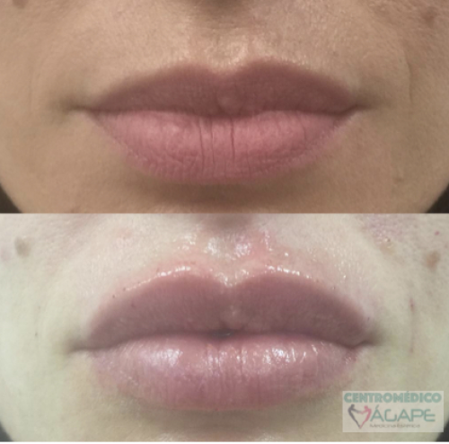 �cido hialur�nico