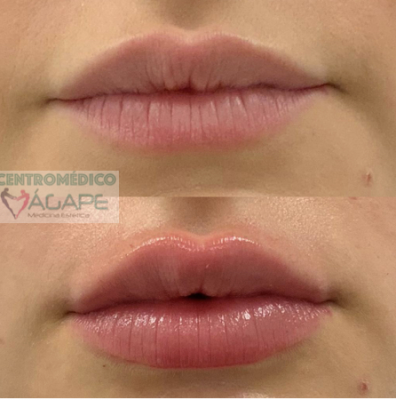Aumento de labios con �cido hialur�nico