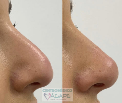 Rinomodelaci�n sin cirug�a