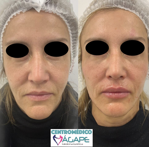 Tratamientos naturales y discretos