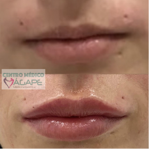 Labios con �cido hialur�nico
