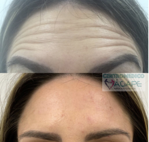 Arrugas de la frente