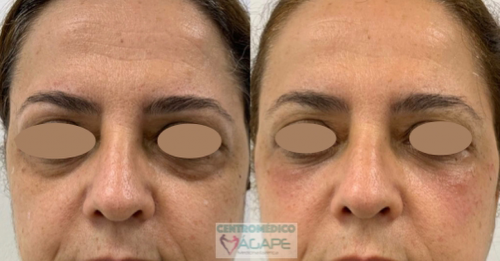 Eliminar bolsas y ojeras