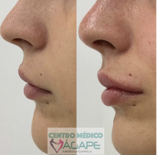 Labios con �cido hialur�nico