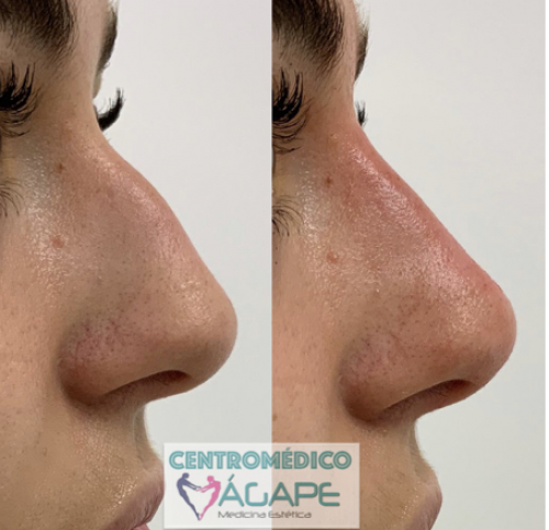 �cido hialur�nico