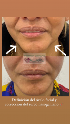 �valo facial definido