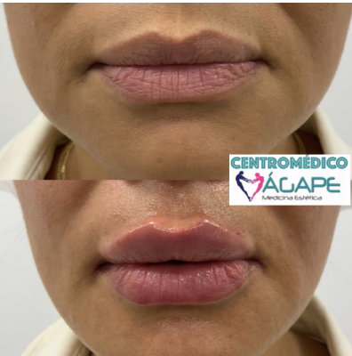 Labios con �cido hialur�nico