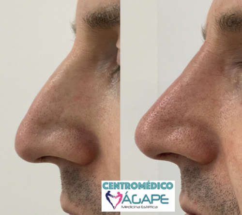 Rinomodelaci�n sin cirug�a