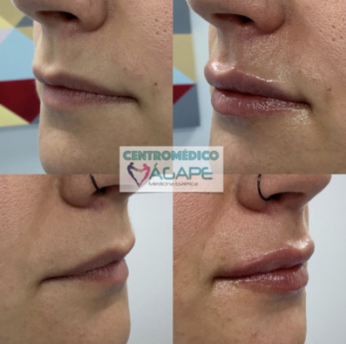 Hidrataci�n de labios