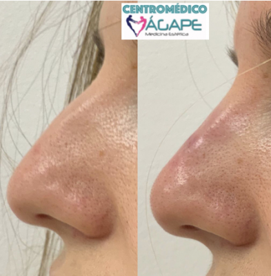 Rinomodelaci�n con �cido hialur�nico