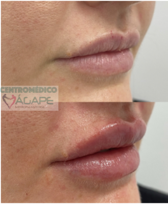 Aumento de labios