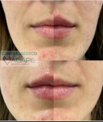 Labios con �cido hialur�nico