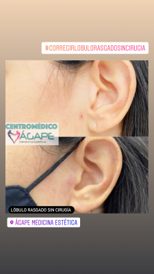 Correcci�n del l�bulo rasgado