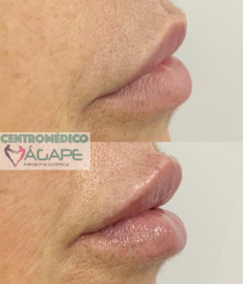 �cido hialur�nico para labios