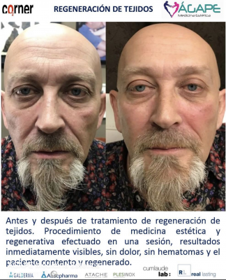 Regeneraci�n de tejidos