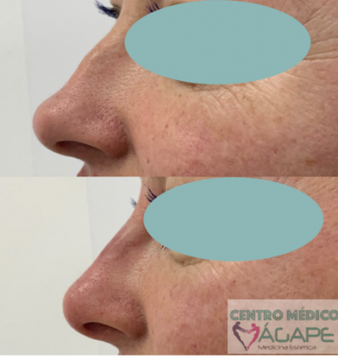 Rinomodelaci�n sin cirug�a