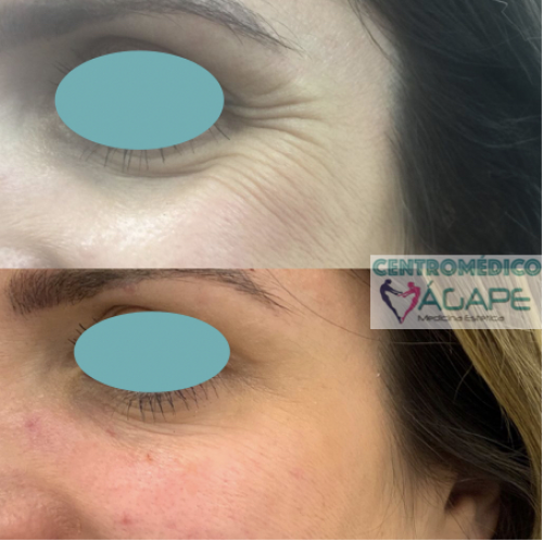 Patas de gallo y ojeras