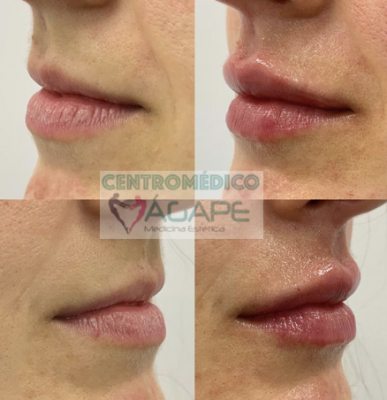 Hidrataci�n y perfilado de labios ?