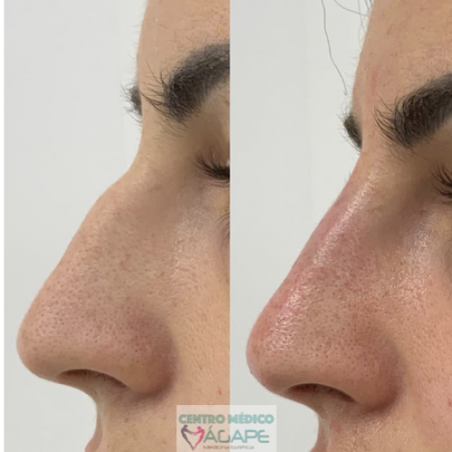 Rinomodelaci�n sin cirug�a