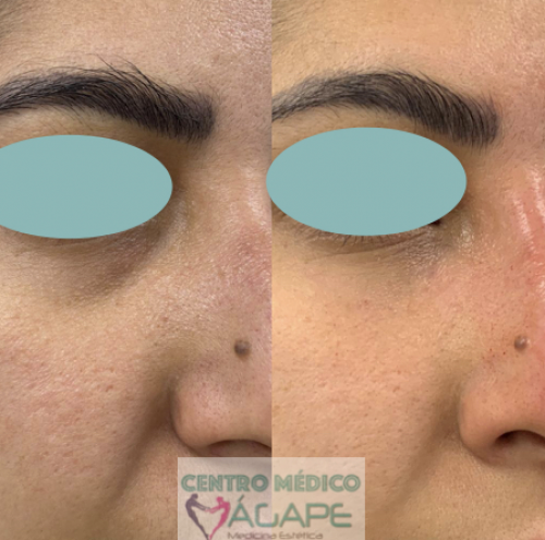 Tratamiento para ojeras