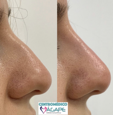 Rinomodelaci�n sin cirug�a