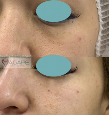 Ojeras con �cido hialur�nico