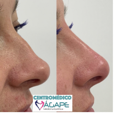 Rinomodelaci�n sin cirug�a