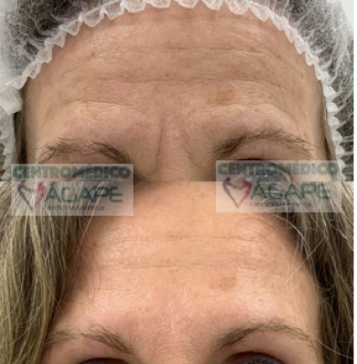 Rejuvenece entrecejo