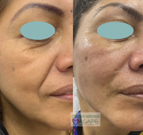 Ojeras y Surco nasogeniano