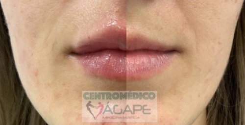 �cido hialur�nico para labios
