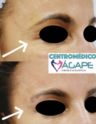 Lifting o elevaci�n de cejas sin cirug�a