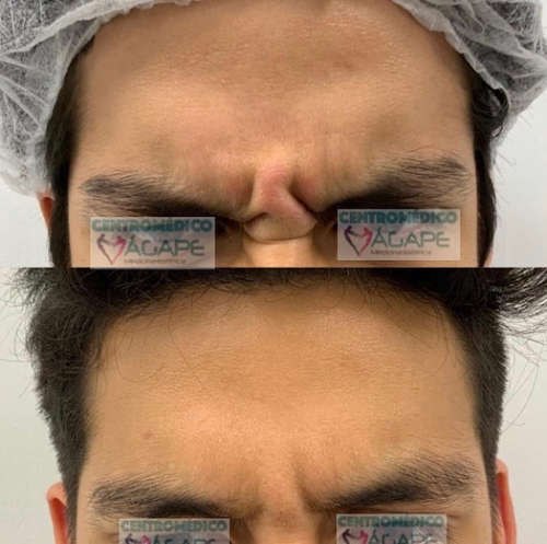 Arruga del entrecejo