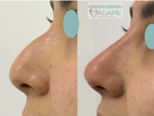 Rinomodelaci�n sin cirug�a