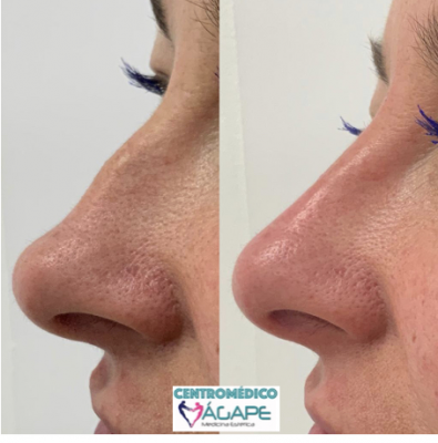 Rinomodelaci�n sin cirug�a