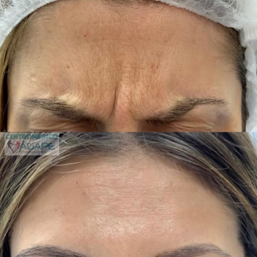 Eliminar arrugas del entrecejo