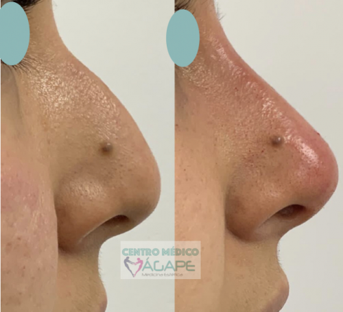 Rinomodelaci�n sin cirug�a