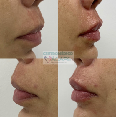 Rejuvenecimiento de labios