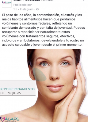 Reposicionamiento de zona malar