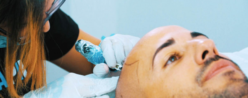 Procedimiento Micropigmentaci�n Capilar