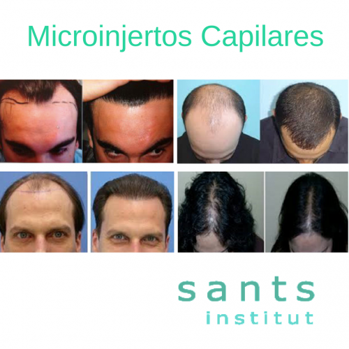 MICROINJERTOS CAPILARES