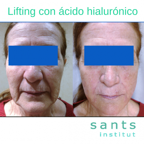 �CIDO HIALUR�NICO