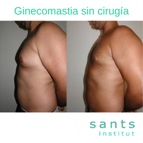 GINECOMASTIA SIN CIRUG�A