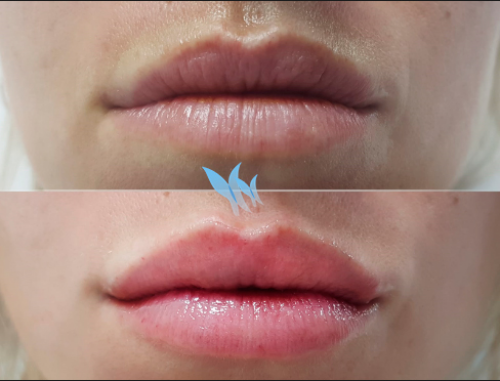 Aumento de labios