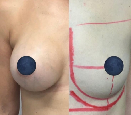 Aumento mamario 2