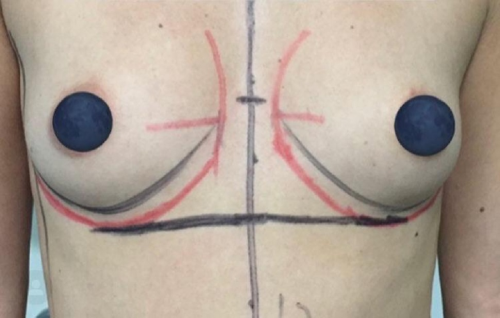 Aumento mamario 1 - PRE